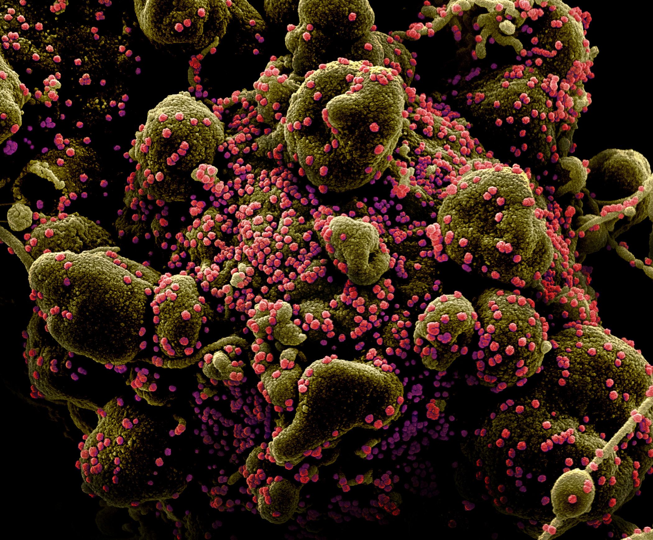 Ковид бактерия. Вирус коронавирус под микроскопом. Вирус Covid 19 под микроскопом. Covid-19 под микроскопом. Вирус коронавирус микроскоп.